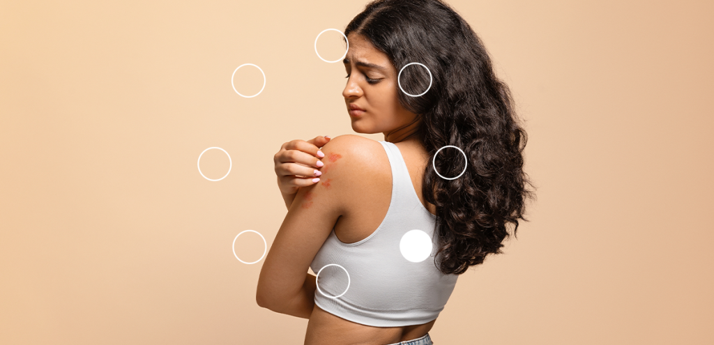 Imagem de uma moça com manchas avermelhadas no braço, simbolizando Dia Nacional e Mundial da Psoríase.