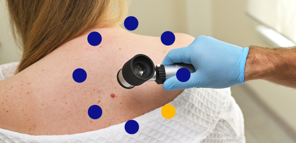 Imagem de um médico avaliando uma pinta, simbolizando a conscientização e prevenção sobre o câncer de pele.