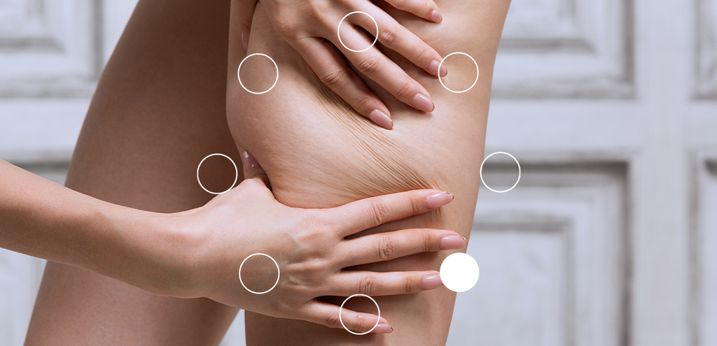 Lipedema: O Que É, Sintomas, Diferenças e Tratamento